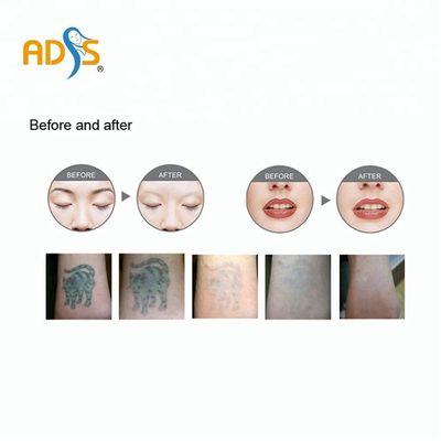OEM / ODM Q스위치 야그 레이저 귀영 나팔 제거 기계 2년 보증